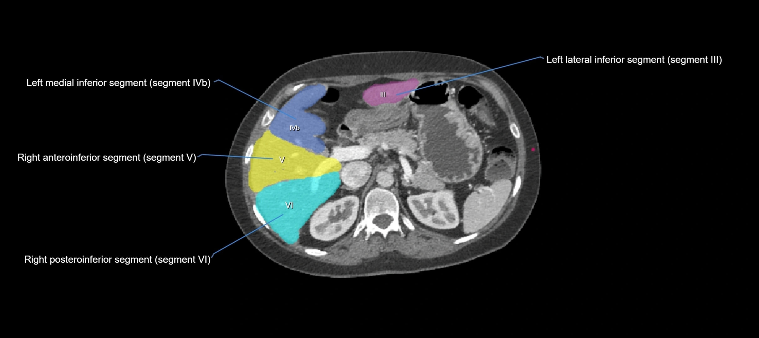 CT liver segments axial cross sectional anatomy labelled image-00041.webp